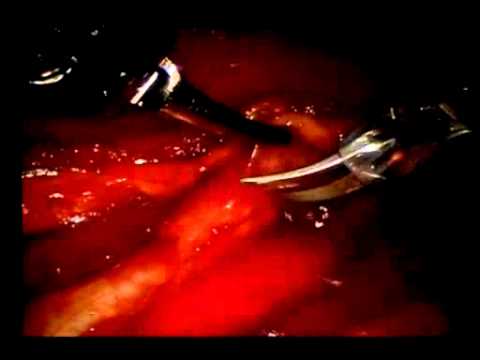 Uretero-Ureterostomia W Asyście Robota Jako Skutek Jatrogennego Zwężenia Moczowodu.