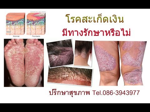 กว่าที่จะรักษากลาก Nummular โรคเบาหวานและโรคเรื้อนกวาง