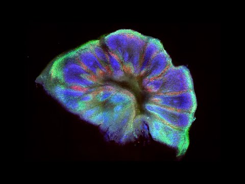 How lab-grown 'mini-brains' can help prevent motor neurone disease