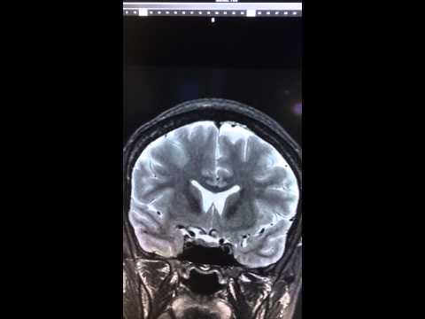 Niedokonany zwrot hipokampa - malrotacja - RM głowy