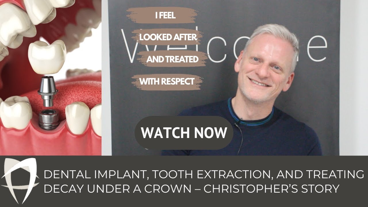 Chris - Single Implant (LL6) - Decay Under Crown