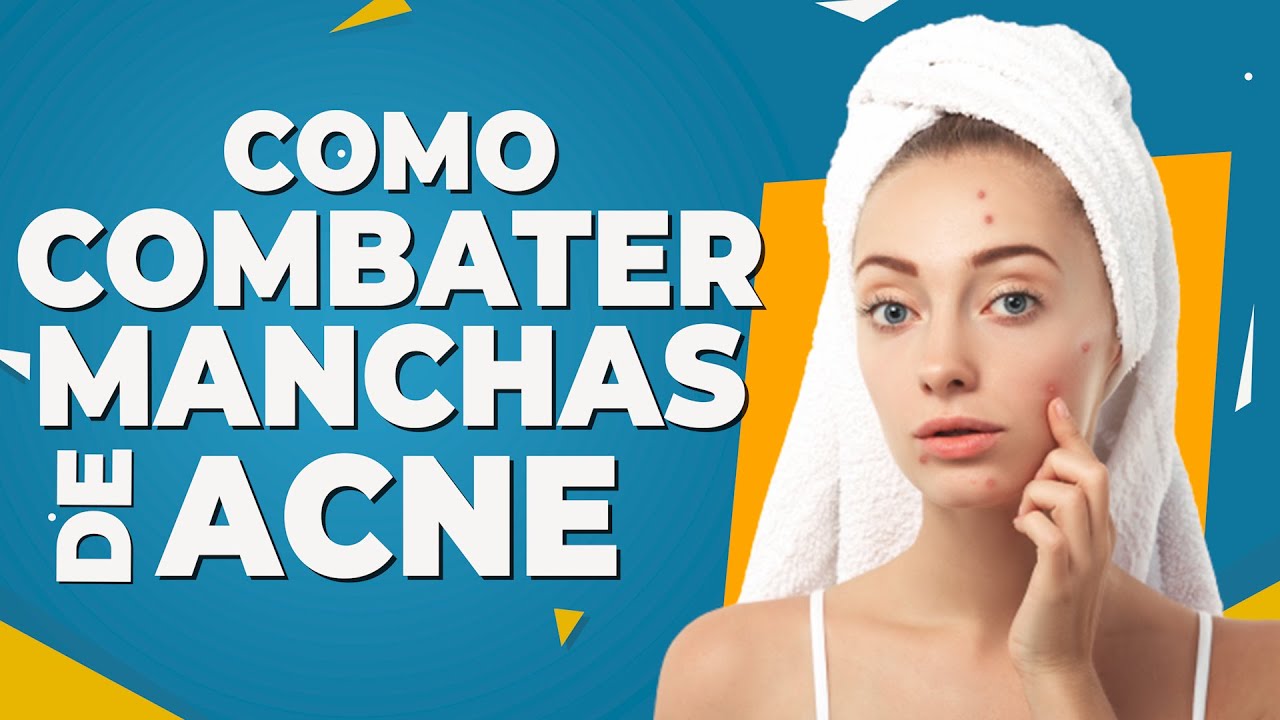 Como Combater Manchas de Acne - Dr Lucas Fustinoni