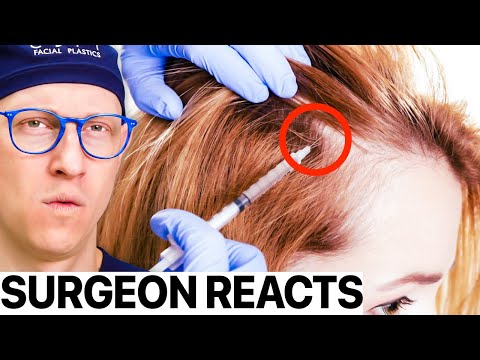 Surgeon Reacts: I Tried PRP For Hair Restoration