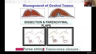 1  Basics of Breast Surgery Webinar