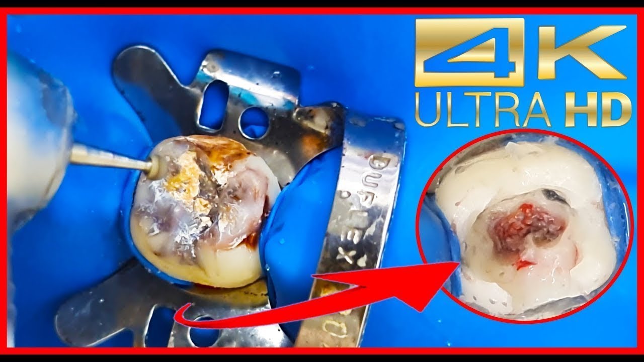 AWESOME: DEEP CARIES removal giving CHANNEL, 4K resolution!!