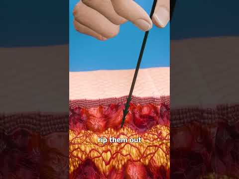 How To Remove Porcupine Quills 😷