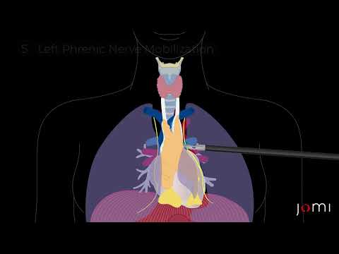 Robotic Thymectomy for Myasthenia Gravis Animation