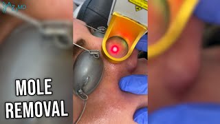 Laser Mole Removal