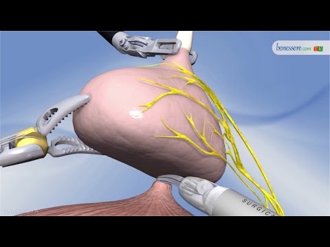 A che età può essere il cancro alla prostata Prostata metastasi ossee del cancro e la luce