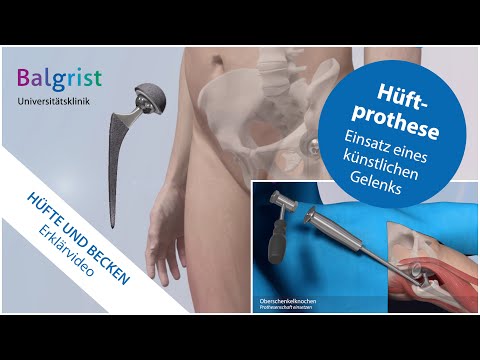 Artificial hip joint for osteoarthritis