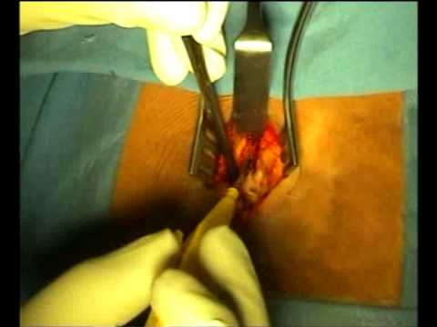 Dolore nella pancia bassa della schiena e laddome si indurisce Protrusione del trattamento del trattamento cervicale