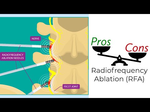 Radiofrequency Ablation - Pros & Cons