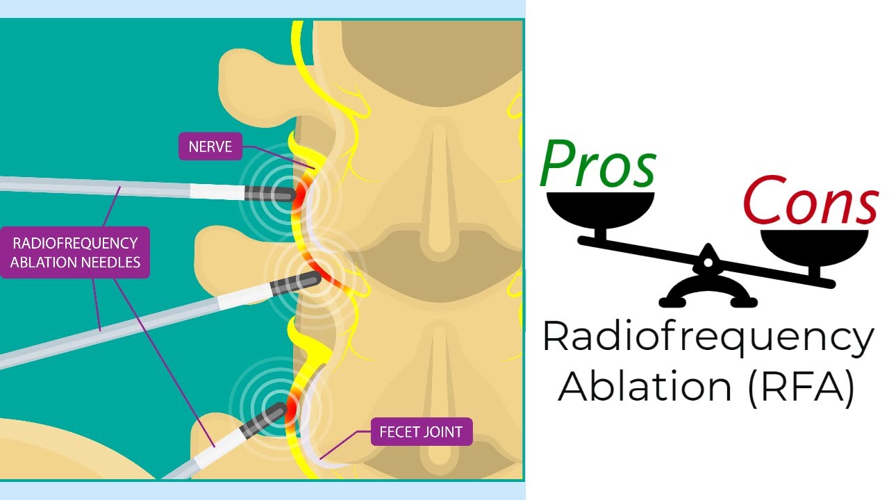How painful is radiofrequency ablation?