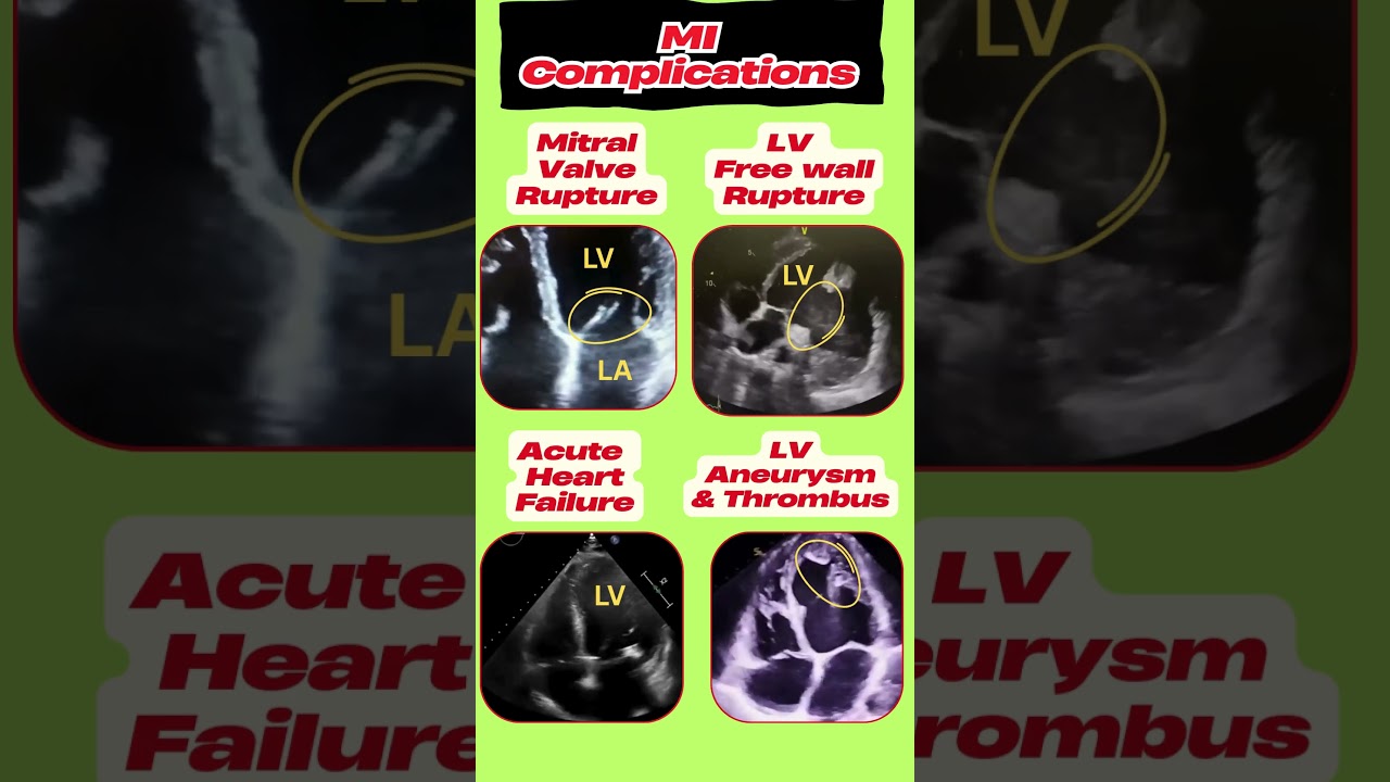 Complications of Myocardial Infarction on Echo