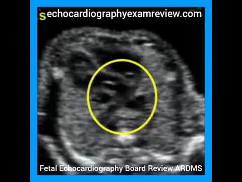 Fetal Echocardiography Transposition of the Great Arteries