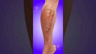 Download lagu How Varicose Veins Develop 😱 #shorts #viralvideo - creativelearning3d mp3