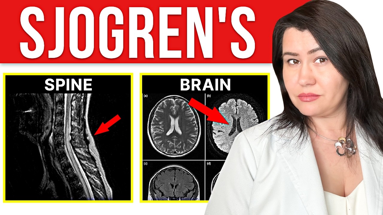 Sjogren's Syndrome Affects the Brain and Spine