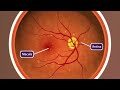 Animation: Age-related Macular Degeneration