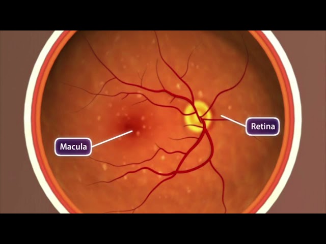 Animation: Age-related Macular Degeneration