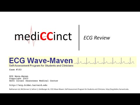 Anterolateral Myocardial Infarction (ECG Wave-Maven) Case #103
