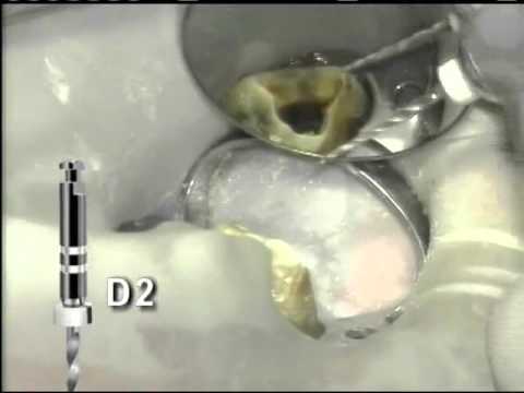 Retreatment using ProTaper® Universal Retreatment Files | Dentsply Sirona