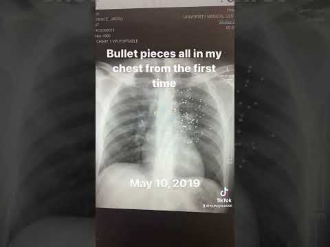 My chest X-rays from getting shot with a shotgun close range