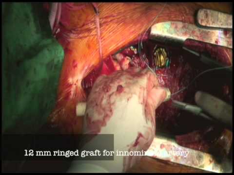 Redo Surgery for Aortic Dissection: Vascular Ring Connector for Total Arch Replacement