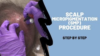 Scalp Micropigmentation (SMP) Procedure Breakdown