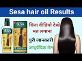 Sesa hair oil results || sesa hair oil kaise use kare | sesa hair oil review | Drx Rabbani