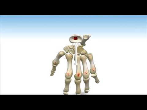 ReMotion™ Total Wrist Arthroplasty - Animated Surgical Technique