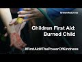 Child First Aid - Helping a child with a burn