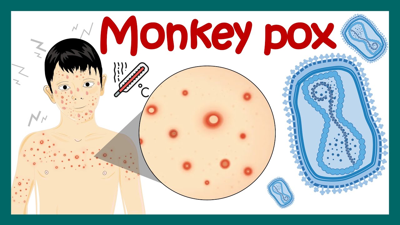 Monkey Pox Virus | How monkey pox is it transmitted? | Symptoms  and treatment of monkey pox