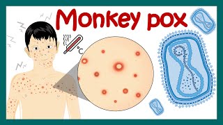 Monkey Pox Virus | How monkey pox is it transmitted? | Symptoms and treatment of monkey pox