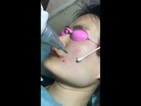 Come togliere su una faccia pigmentary posti I pigmentary notano da una puntura