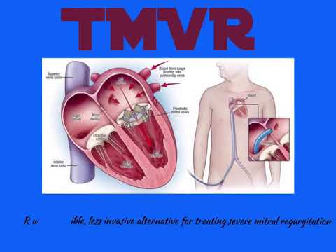 Transcatheter Mitral Valve Replacement  (TMVR) TTE/3D