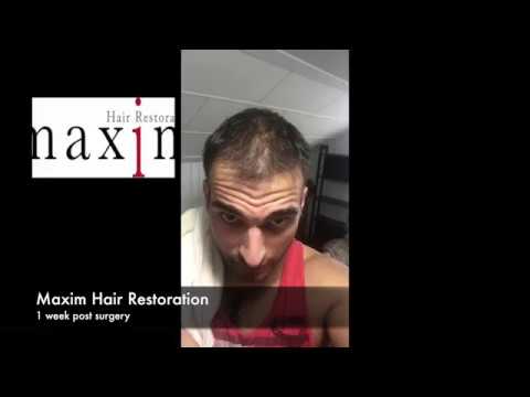 FUE Hair Transplant Recovery Timeline: 1 Week to 3 Months at MAXIM