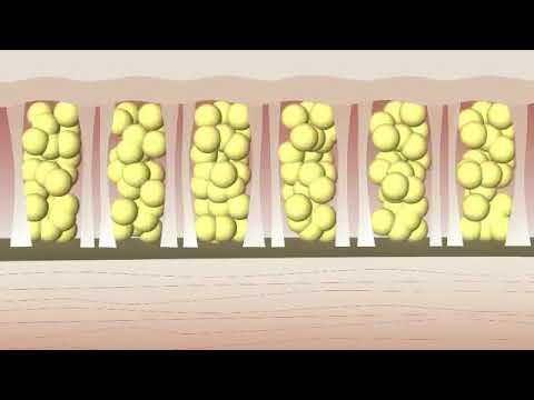 Storz Akustik Dalga Terapisi Hair Inn Mine TOKER Fark ile #22