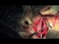 LSCS. Watch a Cesarean section from skin incision ...