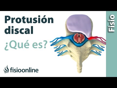 Protrusión o complejos disco osteofitarios posteriores - ¿Qué es?