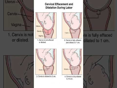 Cervical Effacement and Dilation During Labor Explained | Midwifery Nursing Education