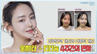 피부탄력 개선 & 이중턱 개선 | 울쎄라 + 티타늄 4주간의 변화!!