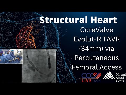 CoreValve Evolut-R TAVR (34mm) via Percutaneous Femoral Access Structural Heart Live - Dec 14, 2016