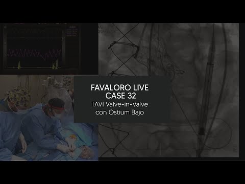 Favaloro Live Case N° 32 - TAVI Valve in Valve con Ostium Bajo