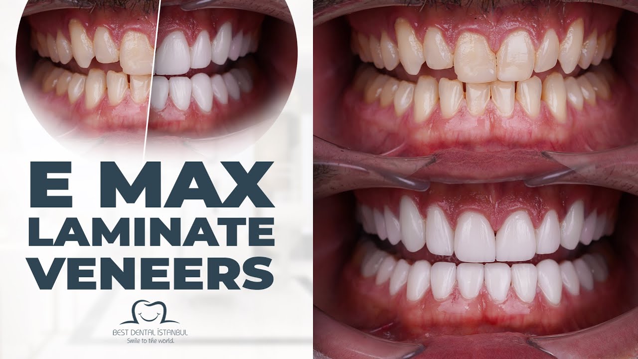 "Cosmetic Dental with Emax Veneers in Istanbul: Kevin's Testimonial from Florida to Turkey"