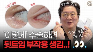 '이렇게' 수술하면 뒷트임 부작용 생김..!