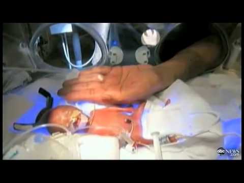 Baby Melinda Video Inspires: Miracle Premature Baby, Size of Human Fist, to Go Home
