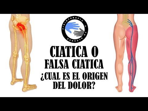 Ciatica o falsa ciatica, como diferenciar el sindrome del piramidal de una hernia