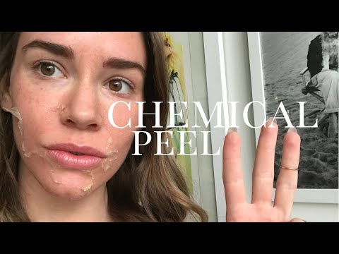 CHEMICAL PEEL before, during, and after @ Queen Bee Salon & Spa | Christa Belle
