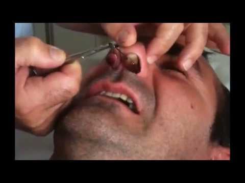 comment traiter sinusite chronique