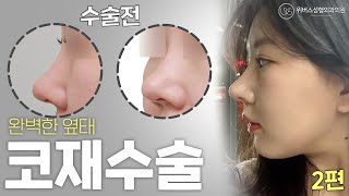완벽한 옆태 코재수술 [2탄]
